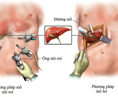 Phẫu thuật cắt túi mật nội soi